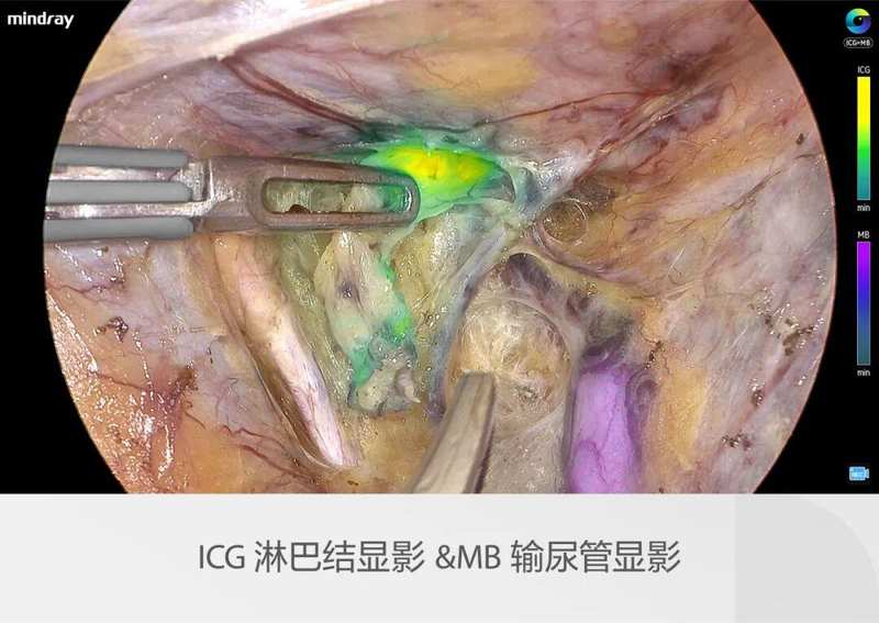  迈瑞全域荧光智能影像平台，探索精准外科未达之“镜” 新闻 迈瑞全域荧光智能影像平台，探索精准外科未达之“镜” 新闻