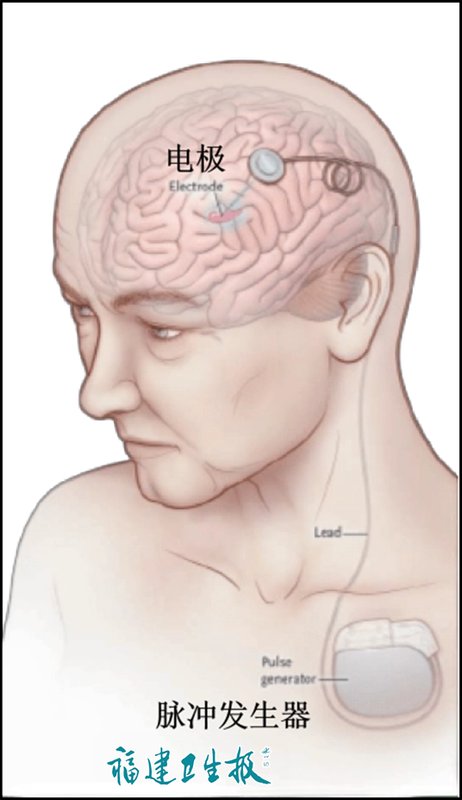  从“节拍器”到“智能管家”：脑深部电刺激术的技术跃迁与临床突破 健康养生