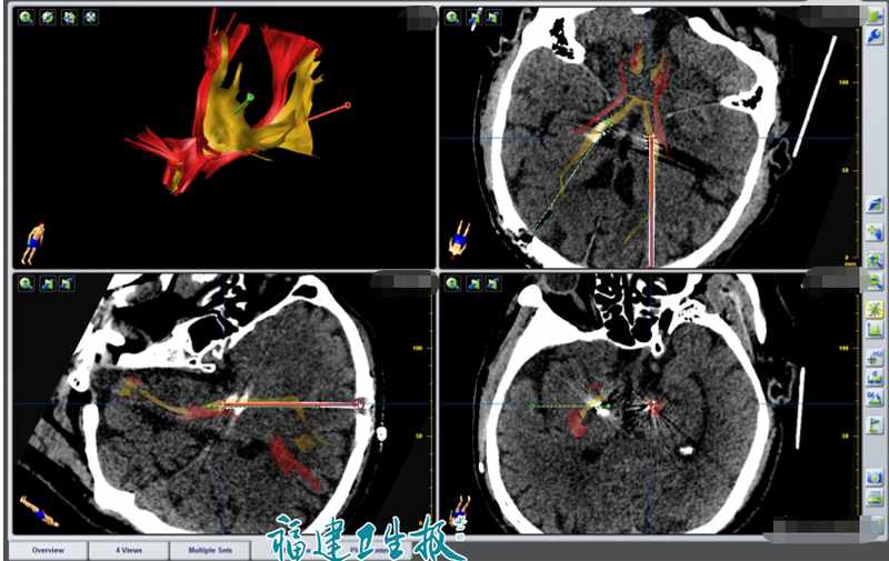  从“节拍器”到“智能管家”：脑深部电刺激术的技术跃迁与临床突破 健康养生